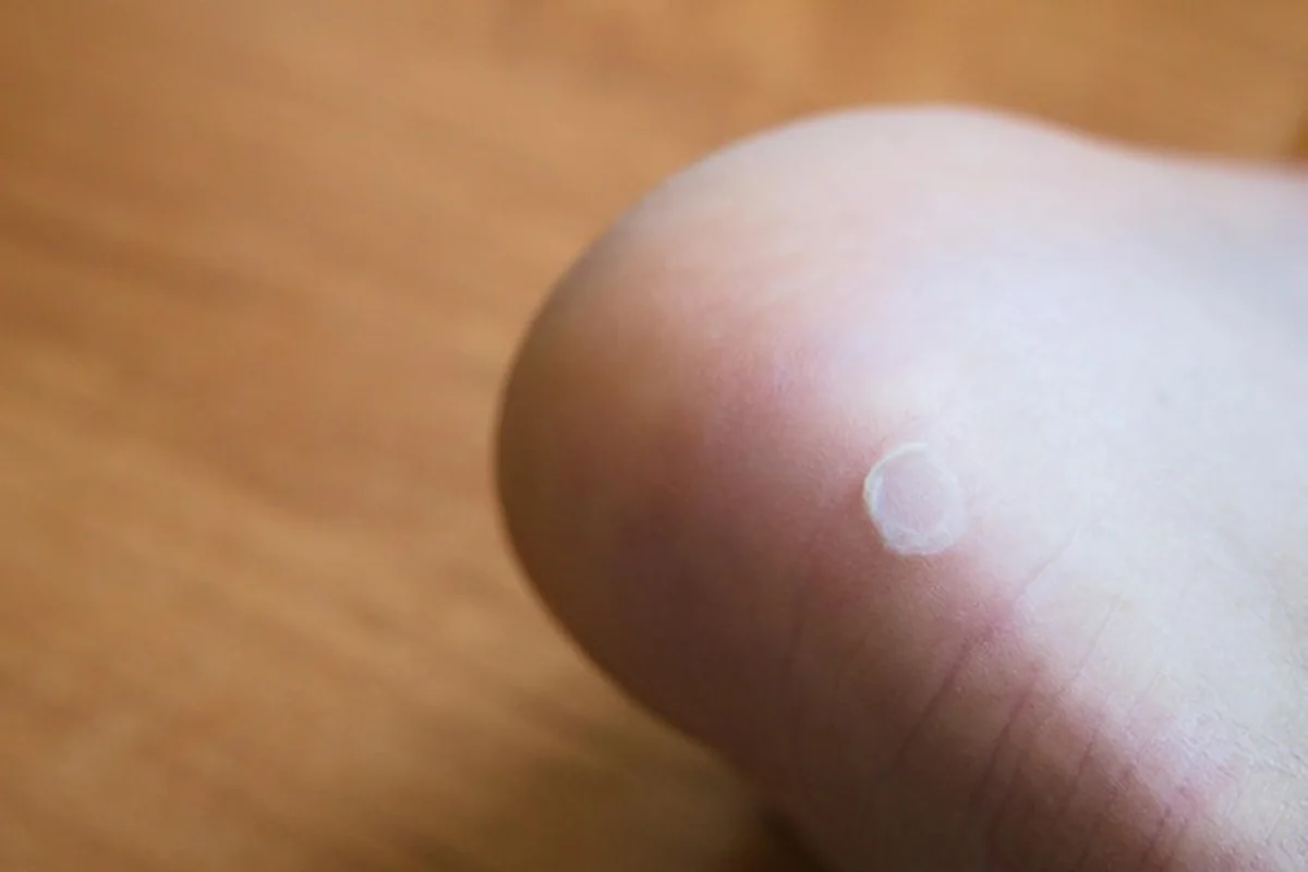 Nowe buty spowodowały odcisk na stopie pięty męskiej nogi na dywanie